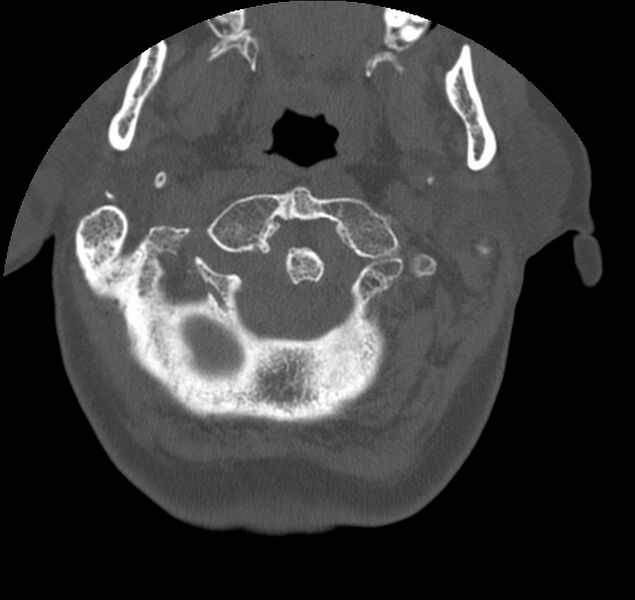 File:Atlanto-occipital assimilation with basilar invagination (Radiopaedia 70122-80188 Axial bone window 16).jpg