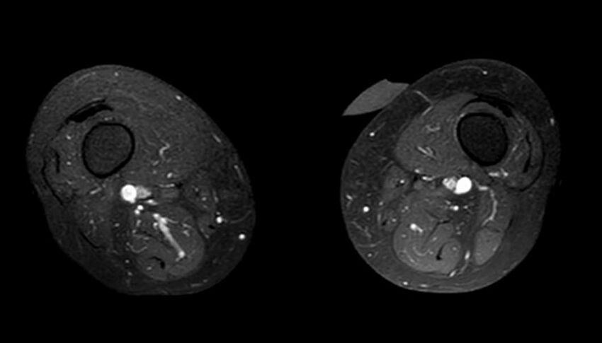 Atypical lipomatous tumor - thigh (Radiopaedia 68975-78734 Axial T1 C+ fat sat 28).jpg