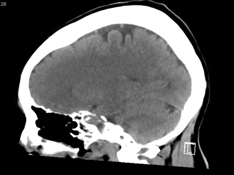 File:Atypical meningioma - intraosseous (Radiopaedia 64915-73867 C 26).jpg