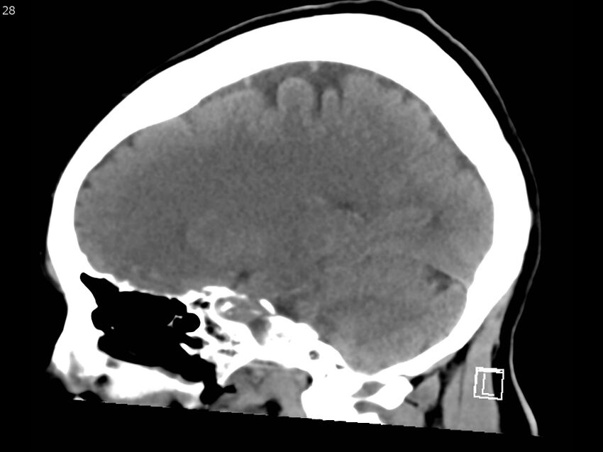 Atypical meningioma - intraosseous (Radiopaedia 64915-73867 C 26).jpg