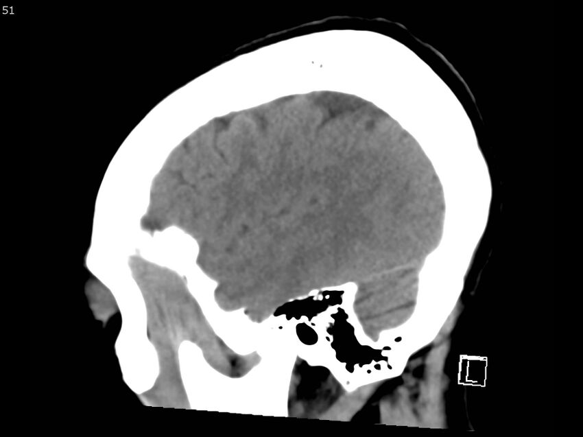 Atypical meningioma - intraosseous (Radiopaedia 64915-73867 C 49).jpg