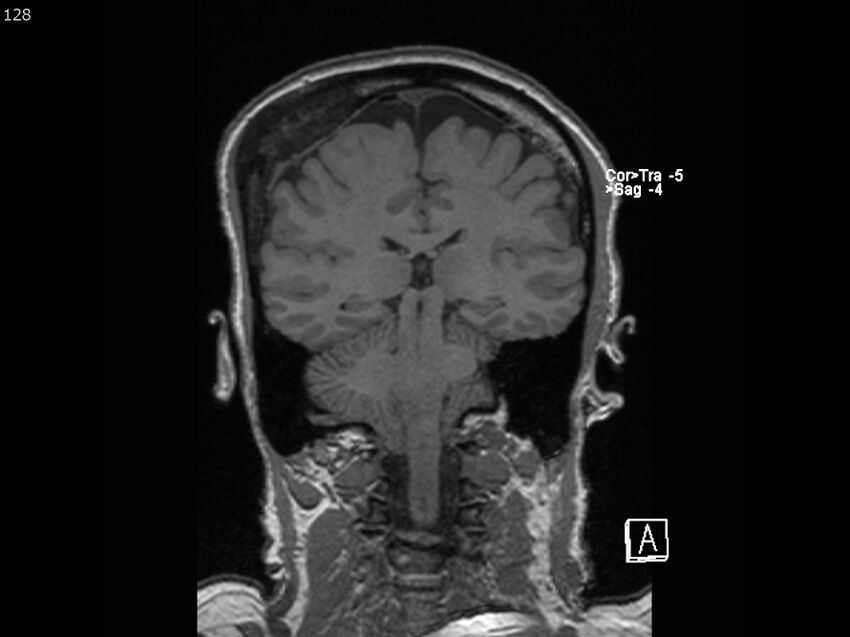 Atypical meningioma - intraosseous (Radiopaedia 64915-74572 Coronal T1 128).jpg