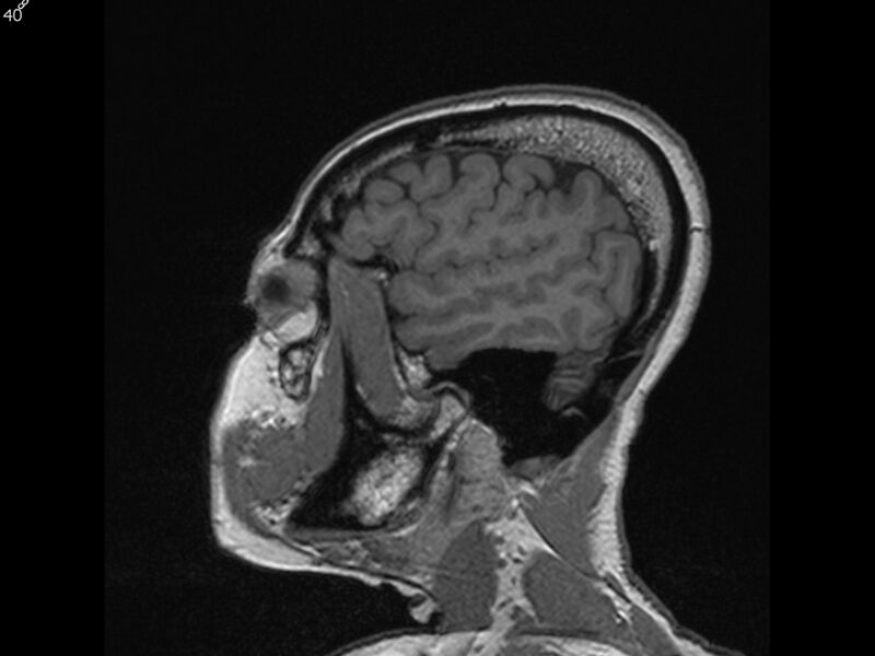 File:Atypical meningioma - intraosseous (Radiopaedia 64915-74572 Sagittal T1 40).jpg