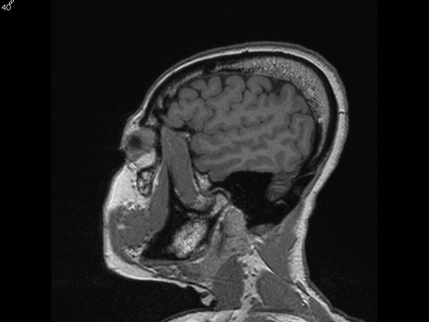 Atypical meningioma - intraosseous (Radiopaedia 64915-74572 Sagittal T1 40).jpg