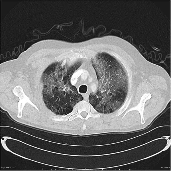 File:Atypical pneumonia - Q fever (Radiopaedia 21993-21989 lung window 7).jpg