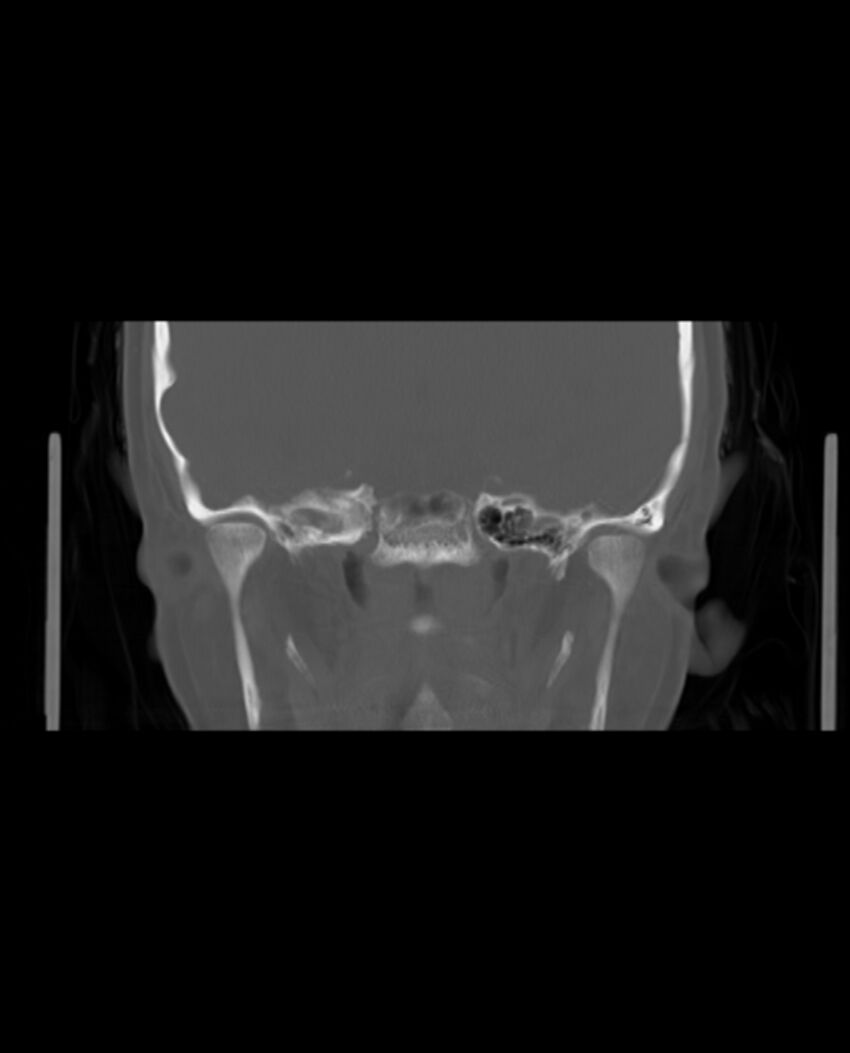 Automastoidectomy with labyrinthine fistula (Radiopaedia 84143-99411 Coronal non-contrast 84).jpg