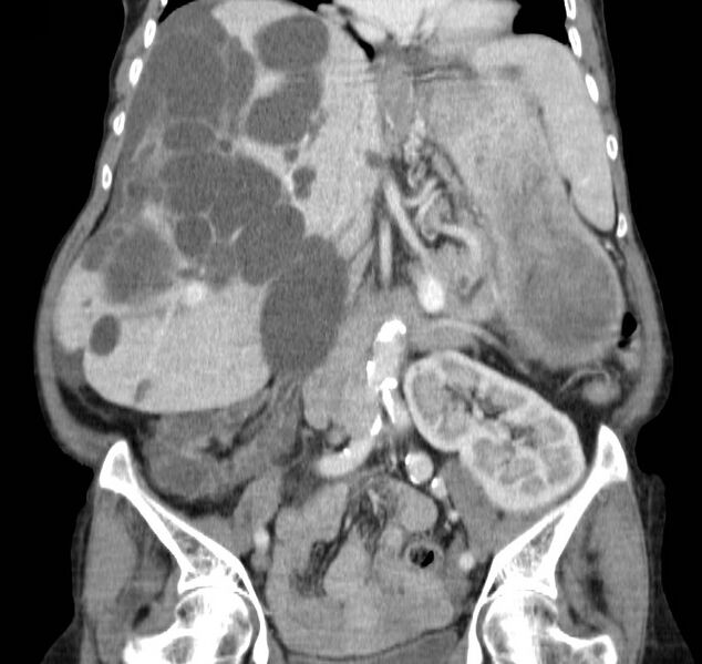 File:Autosomal dominant polycystic kidney disease (Radiopaedia 16777-16490 B 24).jpg