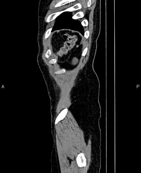 File:Autosomal dominant polycystic kidney disease (Radiopaedia 87830-104287 C 90).jpg