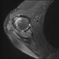 Avulsion fracture - greater tuberosity of humerus (Radiopaedia 71216-81515 Axial PD fat sat 11).jpg