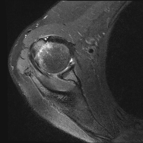 File:Avulsion fracture - greater tuberosity of humerus (Radiopaedia 71216-81515 Axial PD fat sat 11).jpg