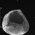 Avulsion fracture of the fibular head (Radiopaedia 74804-85808 Axial PD fat sat 32).jpg