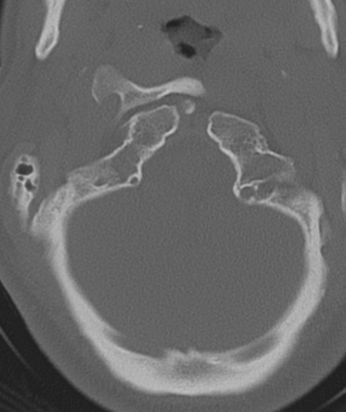 File:Axis peg fracture (type 3) and atlas lateral mass (type 4) fracture (Radiopaedia 37474-39324 Axial bone window 10).png