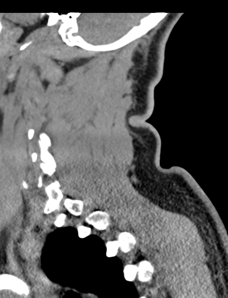 File:Axis peg fracture (type 3) and atlas lateral mass (type 4) fracture (Radiopaedia 37474-39324 D 58).png