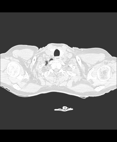 File:Azygos fissure and azygos lobe (Radiopaedia 41841-44832 Axial lung window 35).jpg