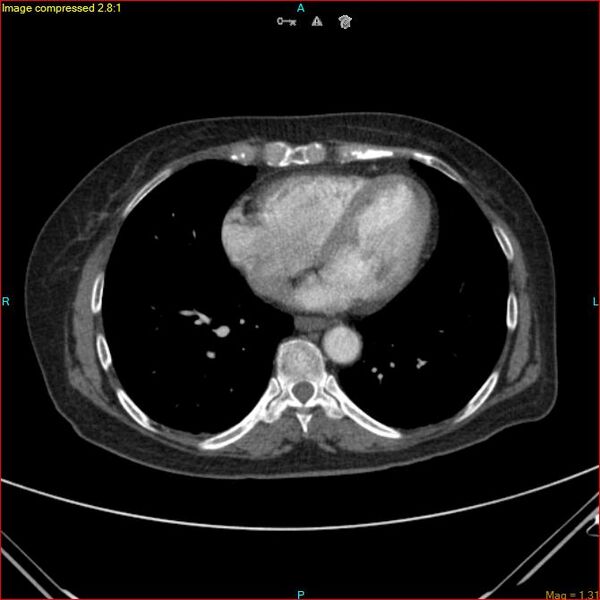 File:Azygos vein aneurysm (Radiopaedia 77824-90130 B 39).jpg