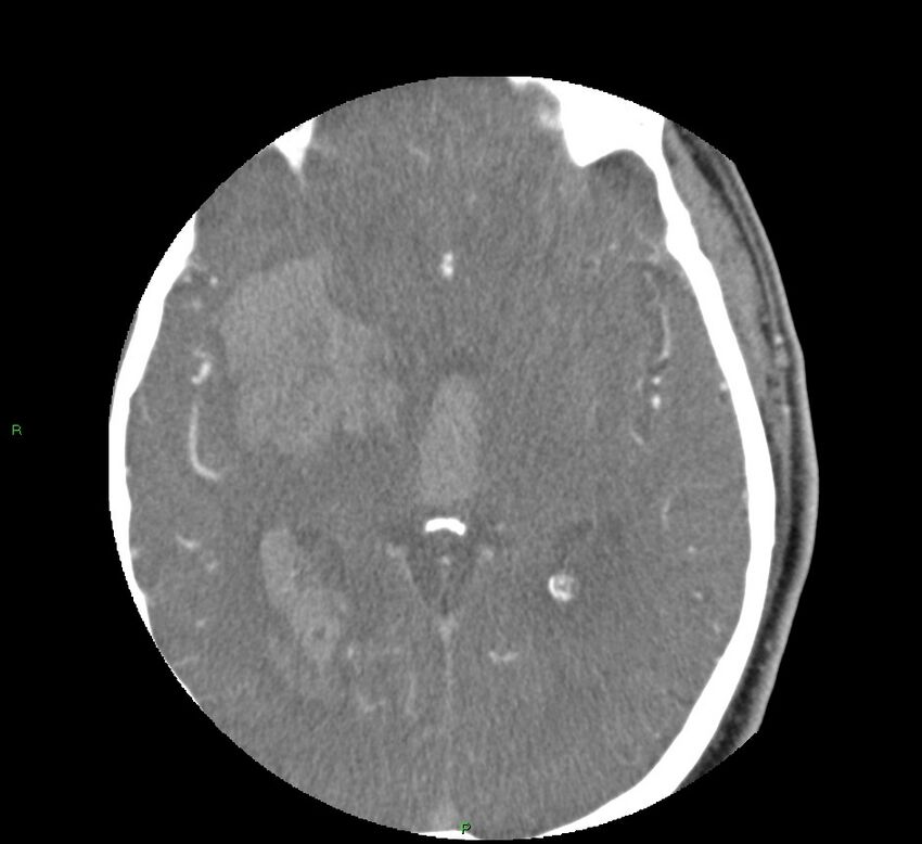 Basal ganglia hemorrhage (Radiopaedia 58763-65985 D 92).jpg