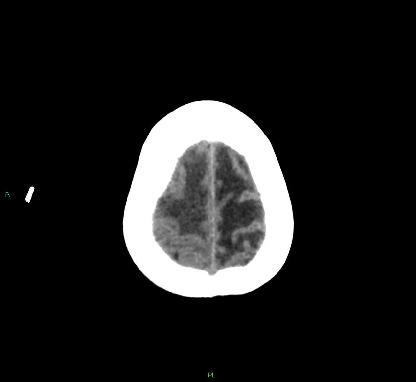 Basal ganglia hemorrhage (Radiopaedia 58766-65988 Axial non-contrast 12).jpg