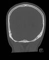 Base of skull fracture with bilateral Le Fort fractures (Radiopaedia 47094-51638 Coronal bone window 22).jpg