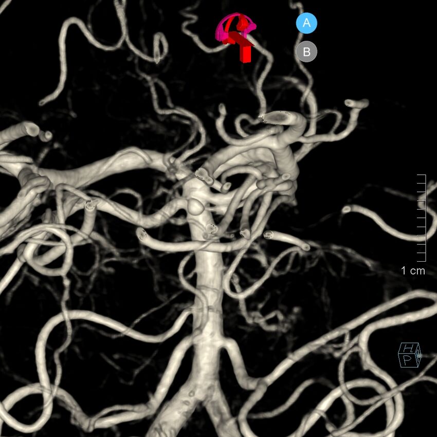 Basilar artery perforator aneurysm (Radiopaedia 82455-97734 3D view left VA 155).jpg