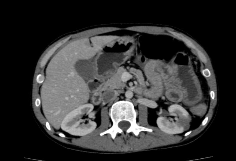 File:Behçet's disease- abdominal vasculitis (Radiopaedia 55955-62570 A 27).jpg