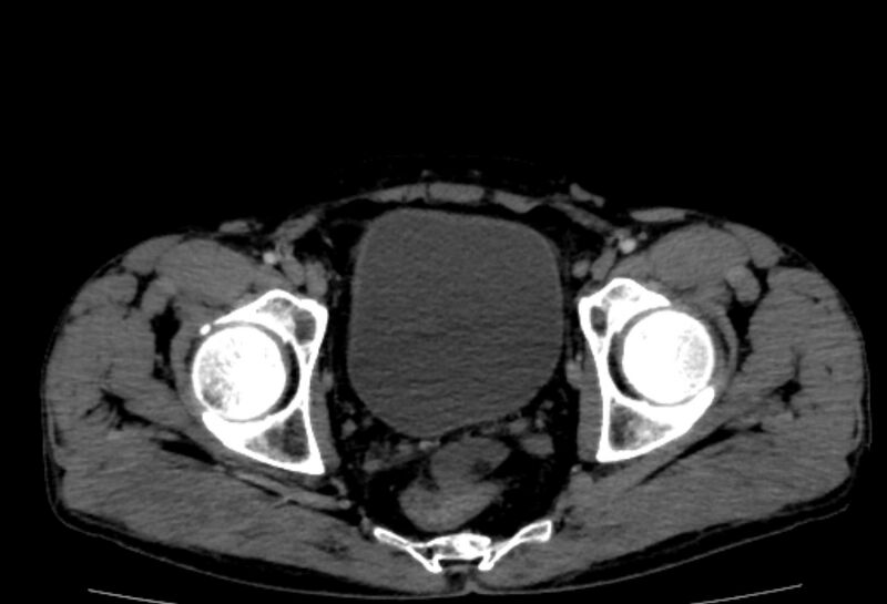 File:Behçet's disease- abdominal vasculitis (Radiopaedia 55955-62570 A 85).jpg