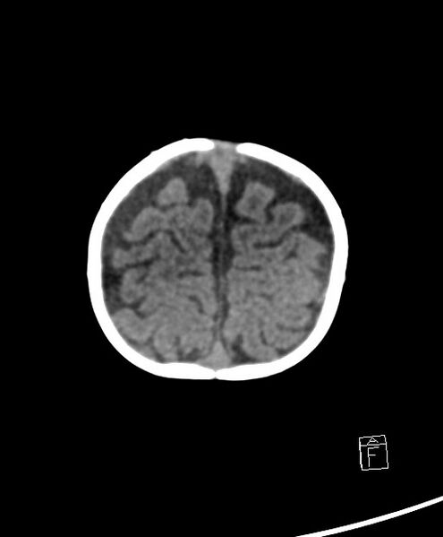File:Benign enlargement of subarachnoid spaces in infancy (BESS) (Radiopaedia 87459-103795 Axial non-contrast 12).jpg
