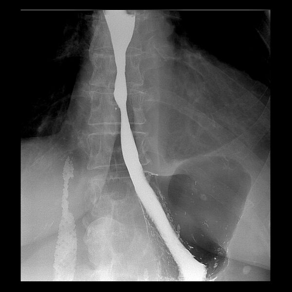 File:Benign esophageal stricture - post reflux (Radiopaedia 75592-86878 F 1).jpg