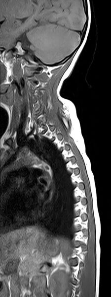 File:Bilateral Sprengel deformity with Klippel-Feil syndrome (Radiopaedia 66395-75650 Sagittal T1 11).jpg