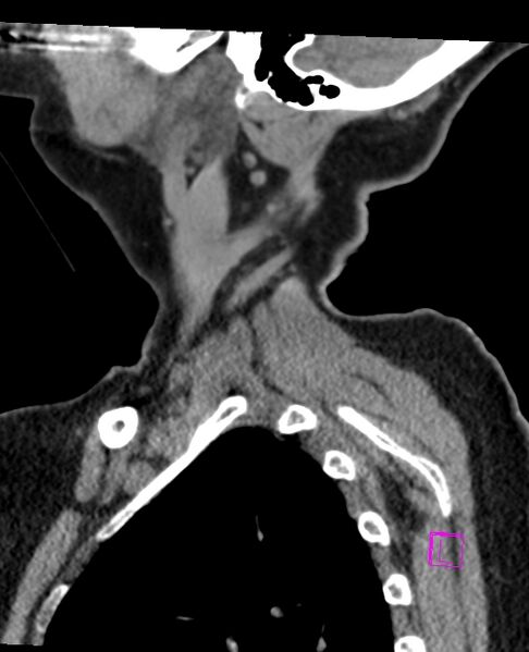 File:Bilateral atlanto-occipital assimilation (Radiopaedia 28350-28603 D 7).jpg