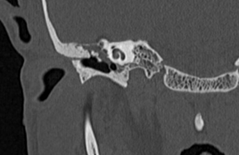 File:Bilateral cholesteatoma (Radiopaedia 54898-61172 Coronal bone window 28).jpg