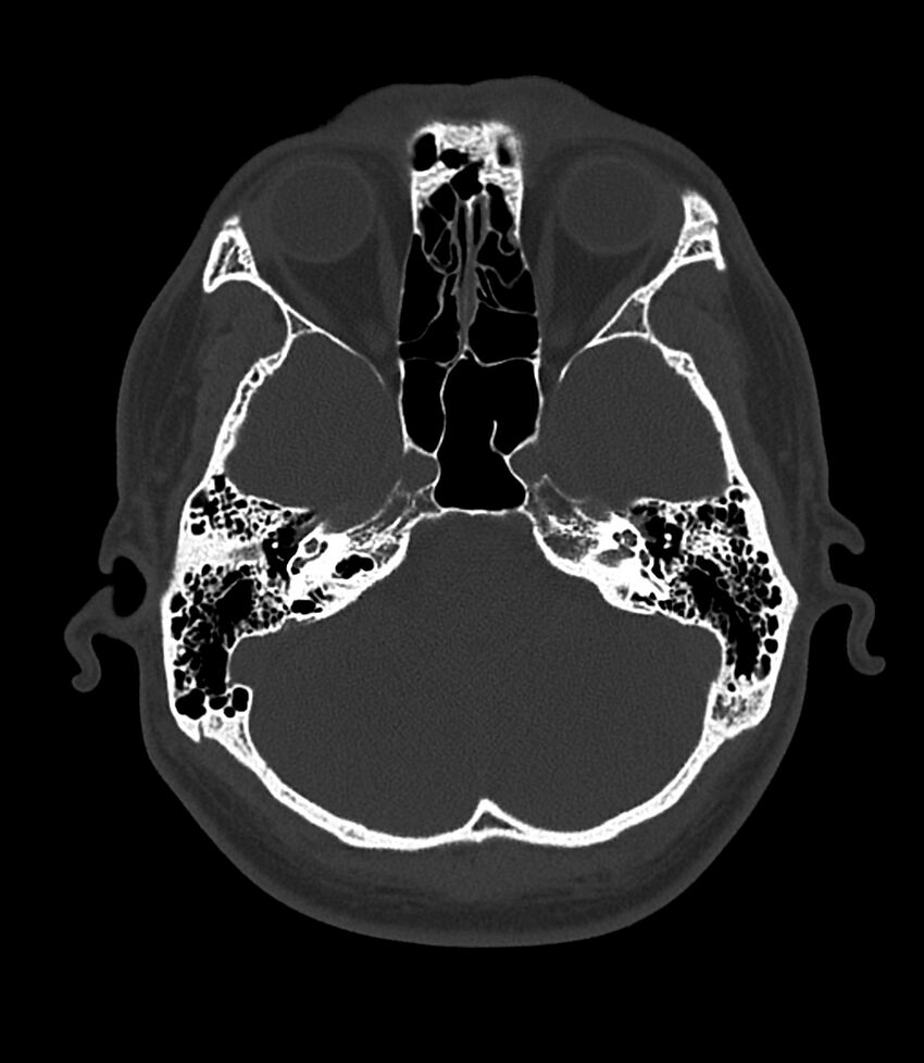 Bilateral medial canal fibrosis (Radiopaedia 85598-101344 Axial bone window 41).jpg