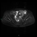 Bilateral ovarian fibroma (Radiopaedia 44568-48293 Axial STIR 11).jpg