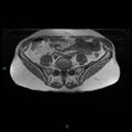 Bilateral ovarian fibroma (Radiopaedia 44568-48293 Axial T1 2).jpg