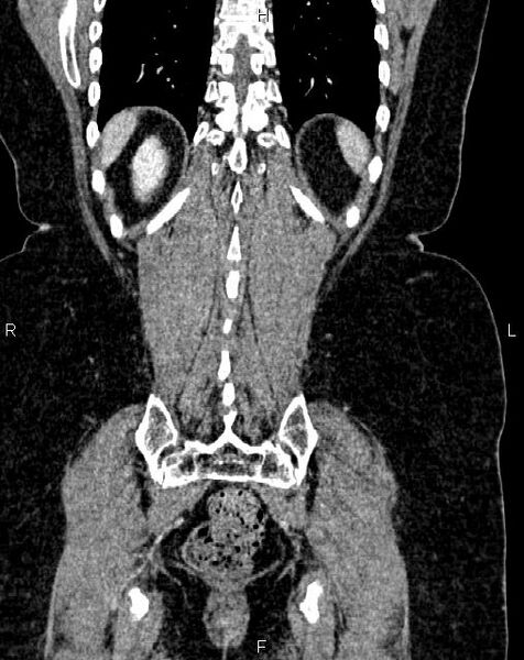 File:Bilateral ovarian serous cystadenocarcinoma (Radiopaedia 86062-101989 D 46).jpg