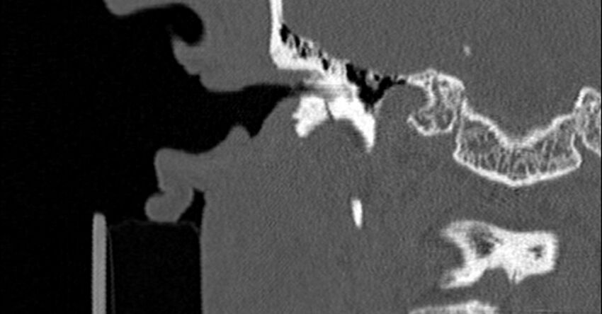 Bilateral temporal bone fractures (Radiopaedia 29482-29970 Coronal non-contrast 82).jpg