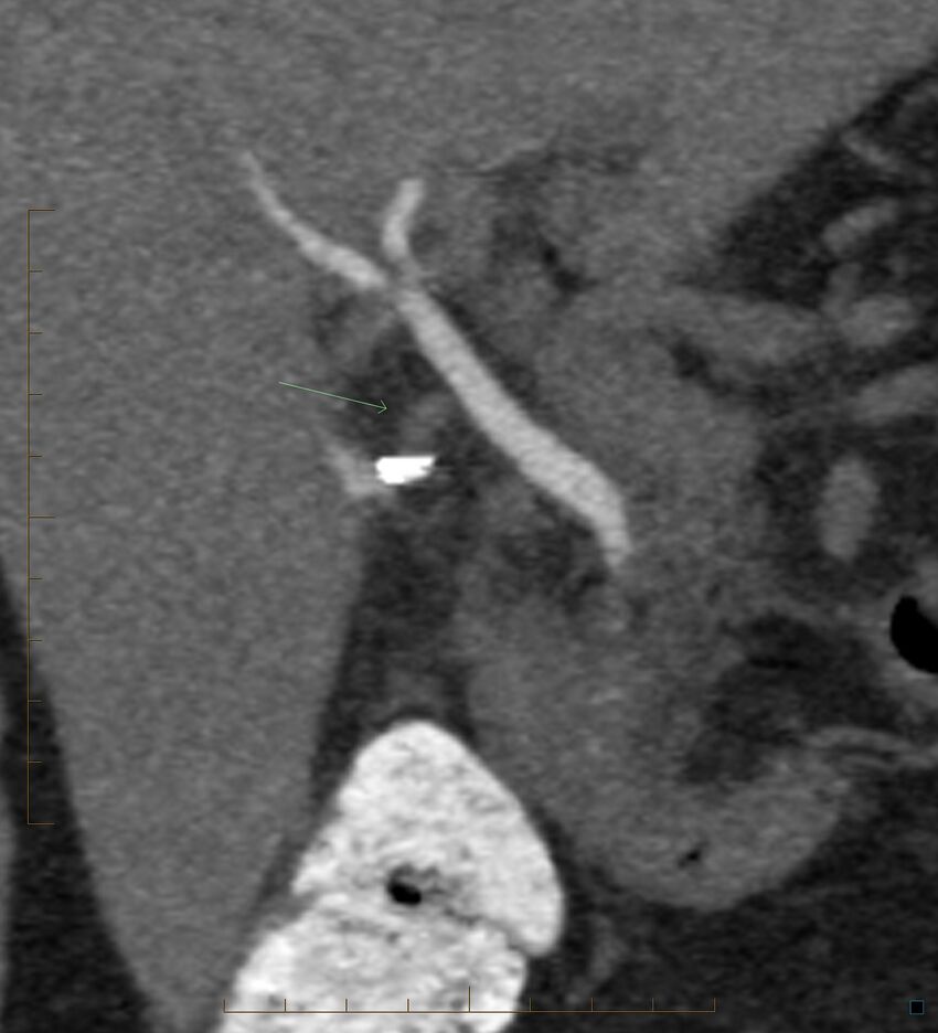 Bile leak from accessory duct(s) of Luschka post cholecystectomy (Radiopaedia 40736-43389 B 34).jpg