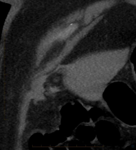 File:Bile leak from accessory duct(s) of Luschka post cholecystectomy (Radiopaedia 40736-43389 B 5).jpg