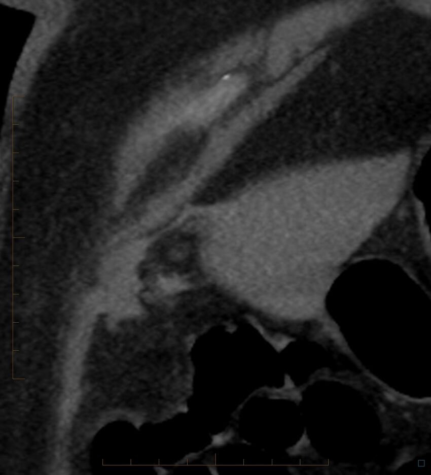 Bile leak from accessory duct(s) of Luschka post cholecystectomy (Radiopaedia 40736-43389 B 5).jpg