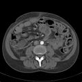 Biliary necrosis - liver transplant (Radiopaedia 21876-21846 A 42).jpg