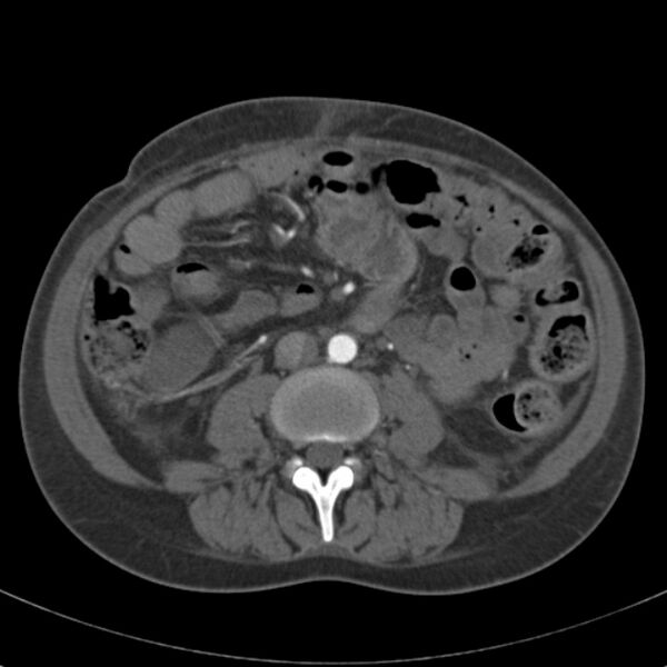 File:Biliary necrosis - liver transplant (Radiopaedia 21876-21846 A 42).jpg