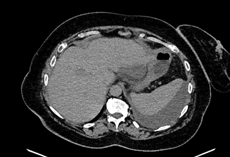 File:Biliary pancreatitis (Radiopaedia 72289-82823 Axial non-contrast 63).jpg