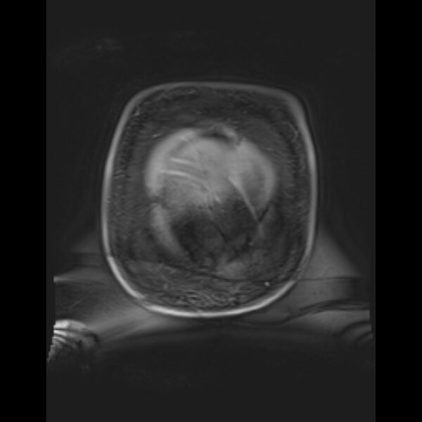 File:Bilobed placenta accreta (Radiopaedia 69648-79591 Coronal T1 vibe 11).jpg