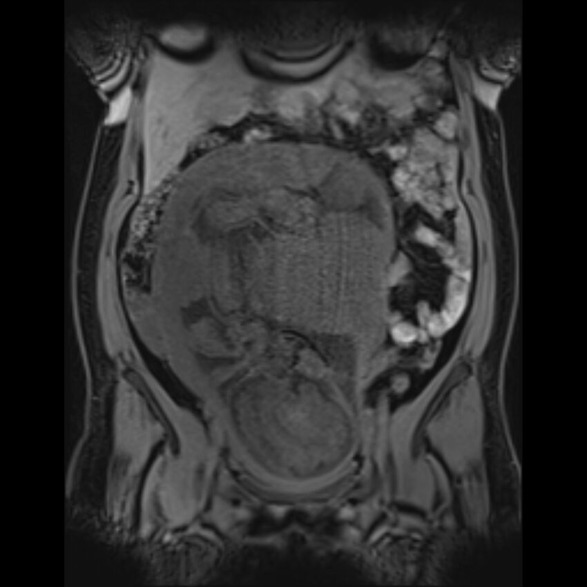 Bilobed placenta accreta (Radiopaedia 69648-79591 Coronal T1 vibe 79).jpg