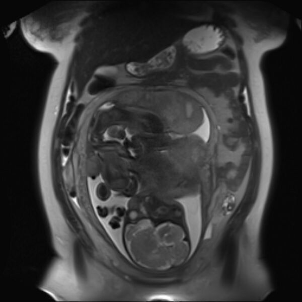 File:Bilobed placenta accreta (Radiopaedia 69648-79591 Coronal T2 16).jpg
