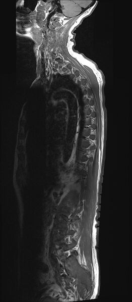 File:Bing-Neel syndrome (Radiopaedia 71453-81799 Sagittal T1 15).jpg