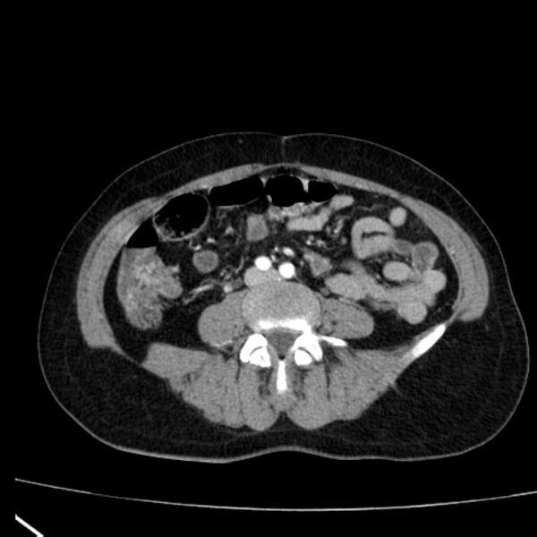 File:Bosniak renal cyst - type I (Radiopaedia 27479-27675 renal cortical phase 56).jpg