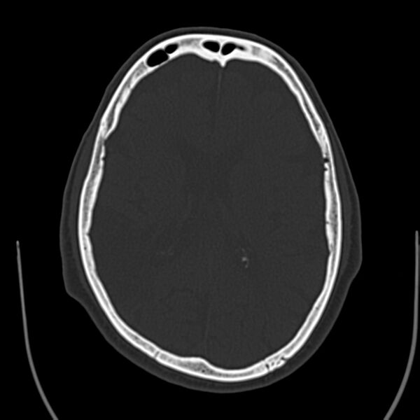 File:Brain Pantopaque remnants (Radiopaedia 78403-91048 Axial bone window 42).jpg