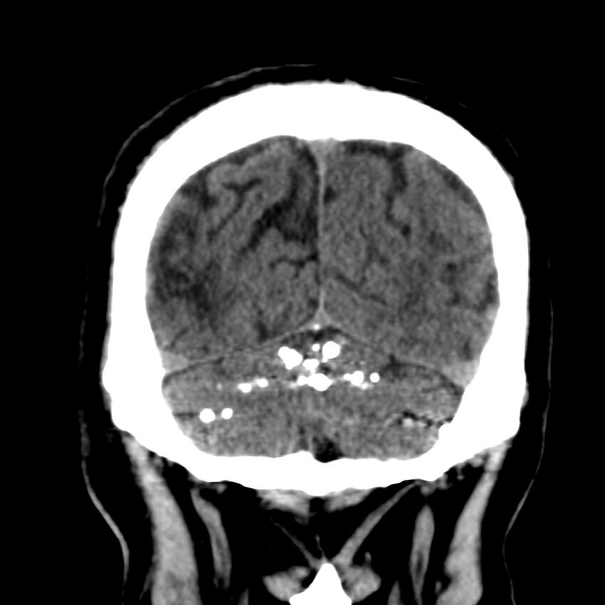 Brain Pantopaque remnants (Radiopaedia 78403-91048 Coronal non-contrast 58).jpg