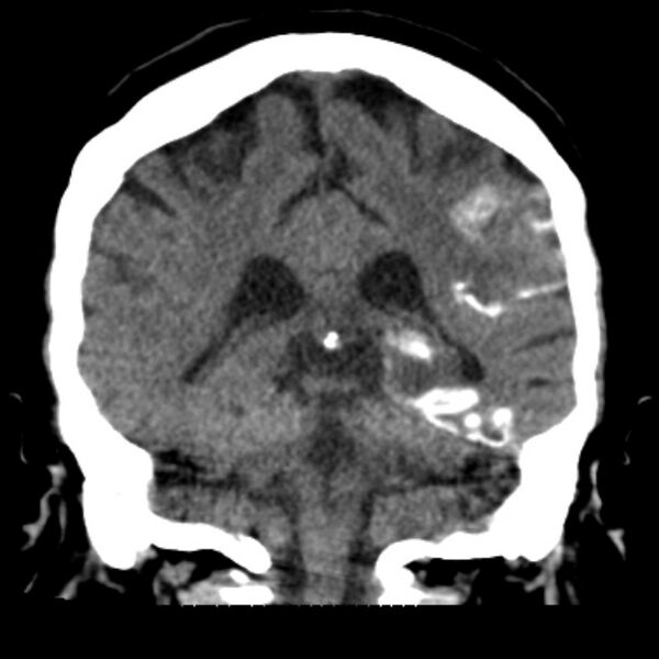 File:Brain cortical laminar necrosis (Radiopaedia 25822-25971 C 36).jpg
