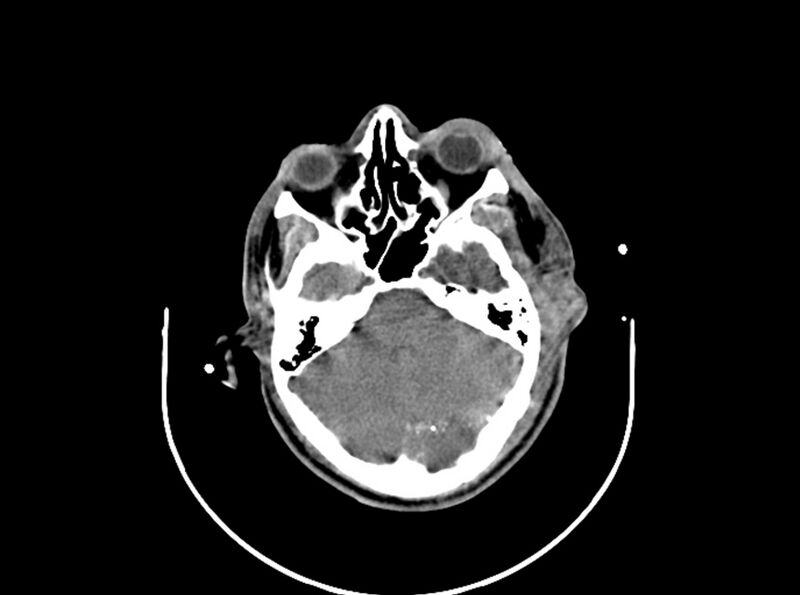 File:Brain injury by firearm projectile (Radiopaedia 82068-96087 B 69).jpg
